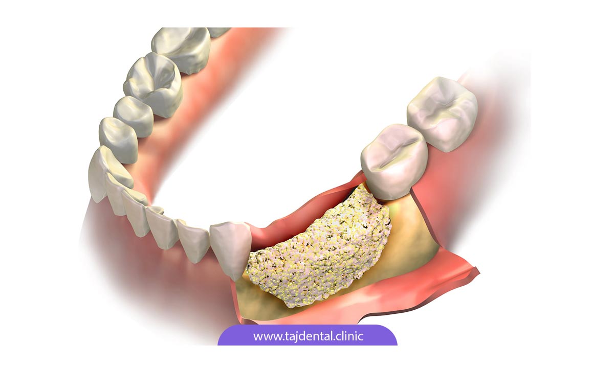 تصویر شماتیک پیوند استخوان در لثه