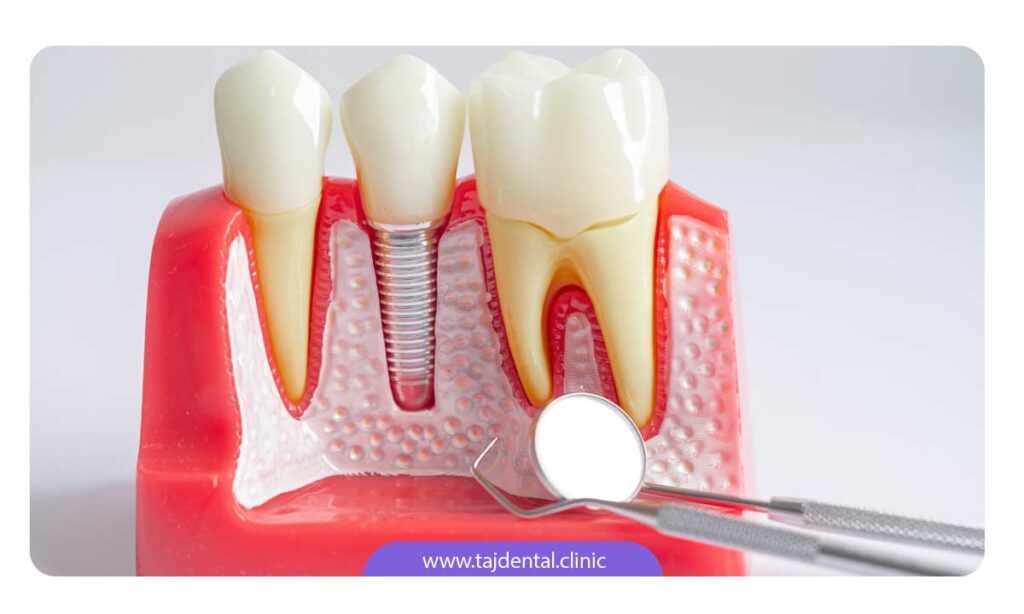 هزینه پیوند استخوان در ایمپلنت