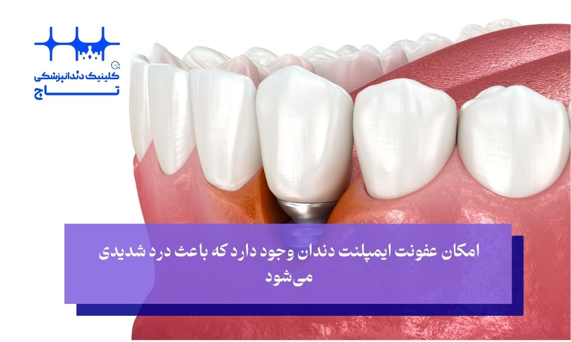 عفونت ایمپلنت دندان