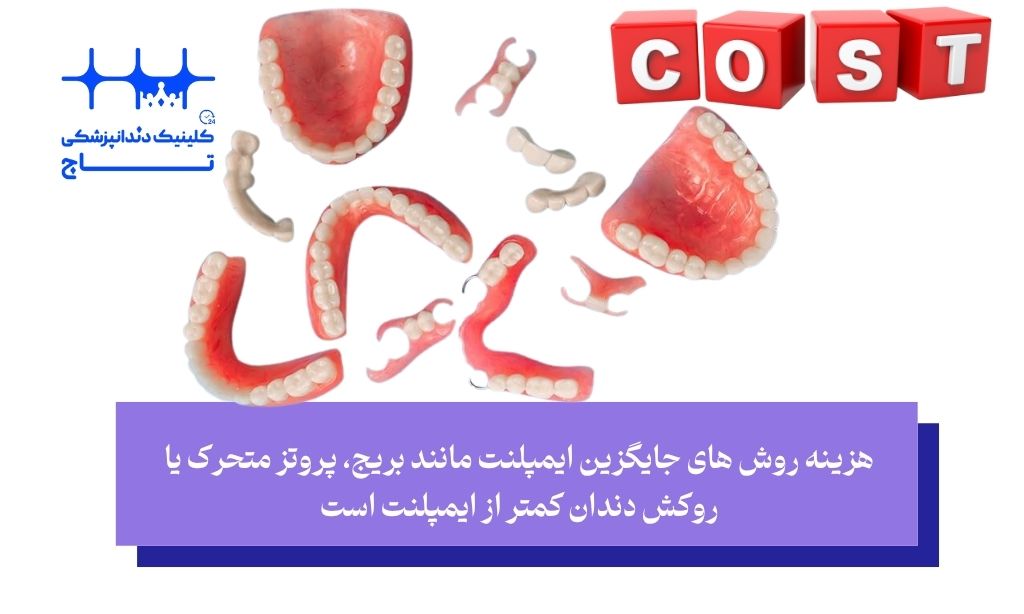 هزینه جایگزین ایمپلنت