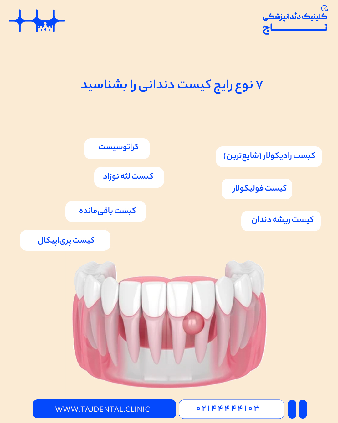 انواع کیست‌های دندانی؛ 7 نوع رایج کیست دندانی