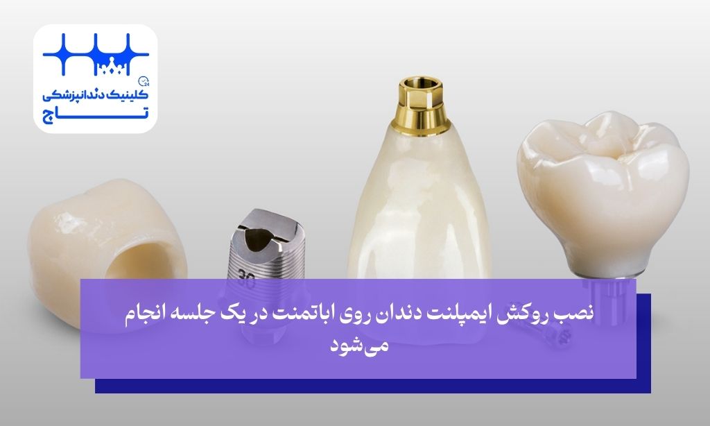 روکش دندان ایمپلنت؛ چقدر طول می‌کشد؟