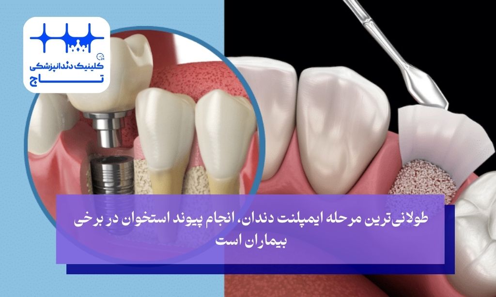 پیوند استخوان (گرافتینگ)؛ طولانی‌ترین مرحله ایمپلنت دندان