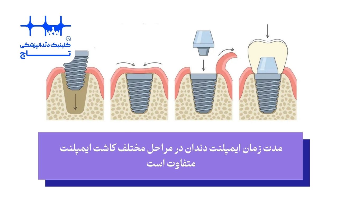 مراحل و مدت زمان ایمپلنت دندان