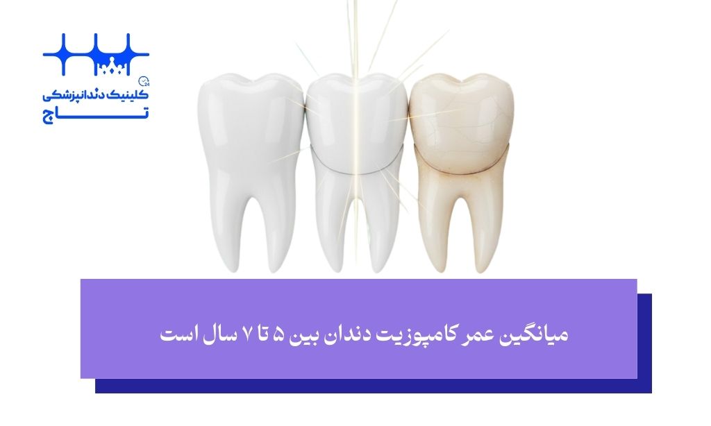 کامپوزیت دندان چند سال عمر میکند؟