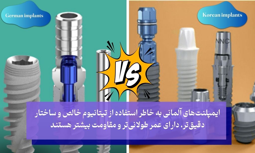 ایمپلنت آلمانی بهتره یا کره‌ ای