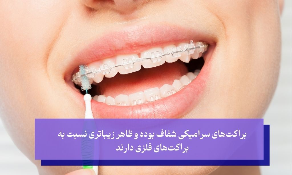 براکت‌های سرامیکی برای بزرگسالان