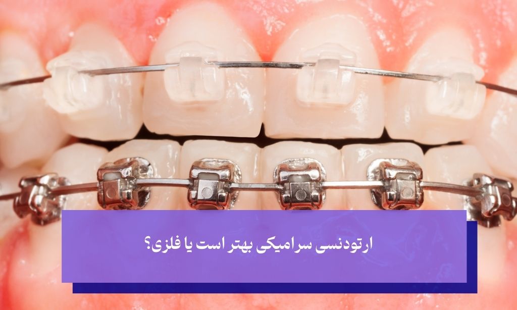 ارتودنسی سرامیکی بهتر است یا فلزی؟