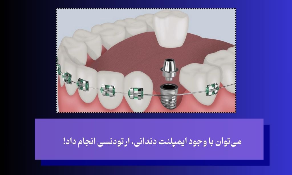 آیا می‌توان با وجود ایمپلنت دندانی ارتودنسی انجام داد؟