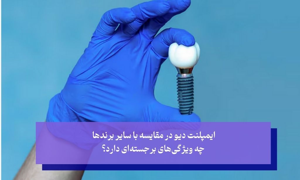 مقایسه ایمپلنت دیو با سایر برندهای ایمپلنت دندانی