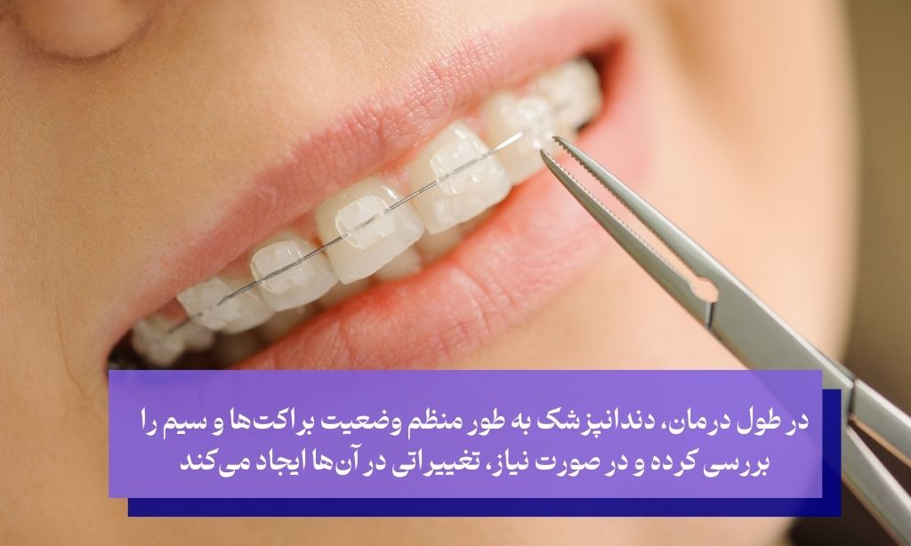 مراحل نصب ارتودنسی سرامیکی