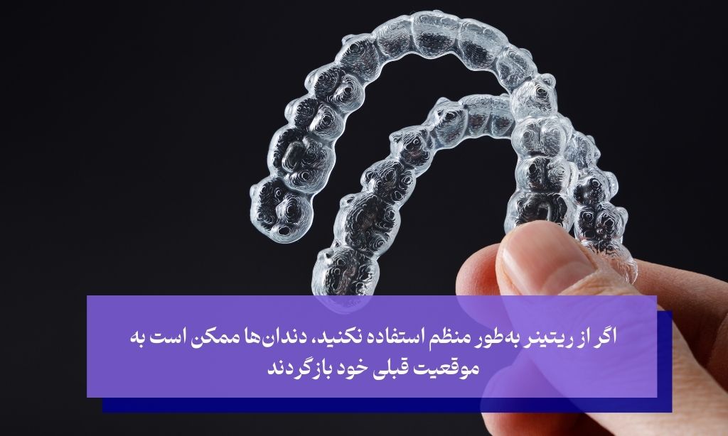 چرا باید از ریتینر استفاده کرد؟
