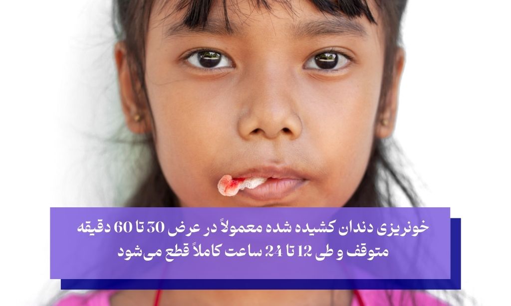 خونریزی بعد از کشیدن دندان تا چند ساعت طبیعی است