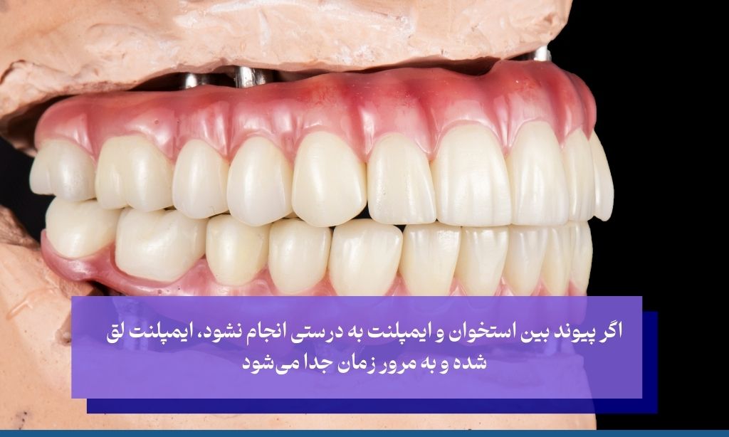جوش خوردن ایمپلنت به چه معنا است و چرا اهمیت دارد