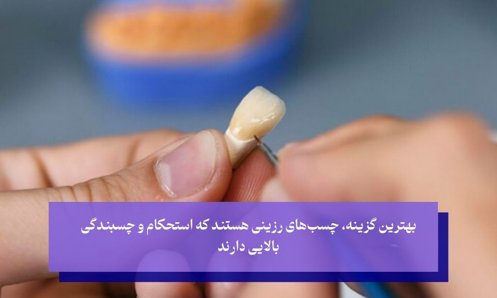 چگونه بهترین چسب دندان روکش را انتخاب کنیم؟