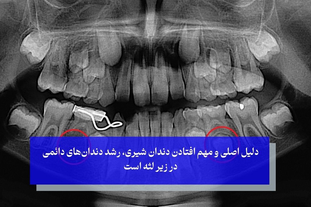 علت افتادن دندان شیری در 5 سالگی