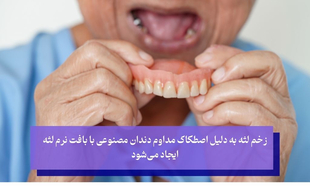 زخم شدن لثه زیر دندان مصنوعی؛ چرا زخم لثه ناشی از دندان مصنوعی ایجاد می‌شود؟