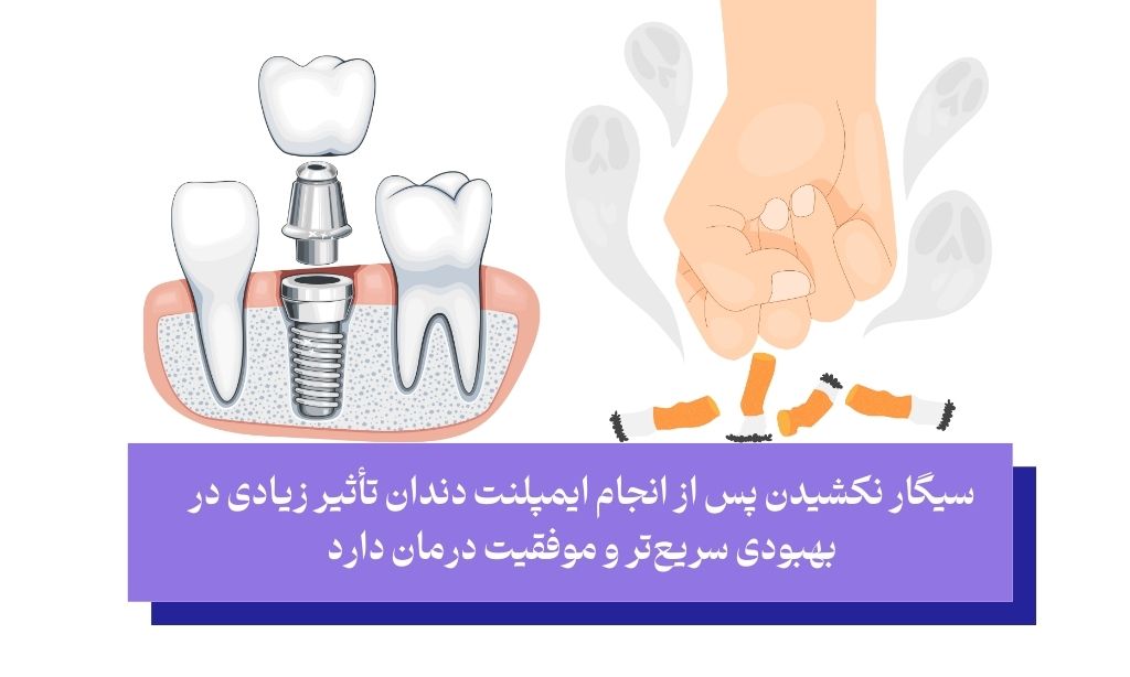 ترک سیگار پس از ایمپلنت