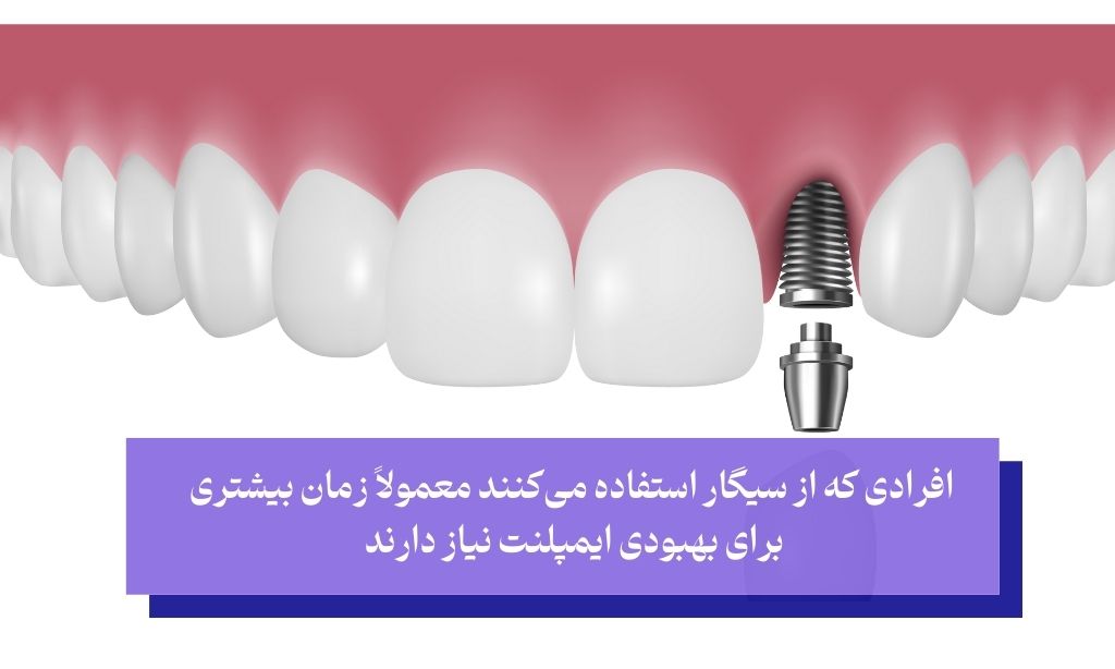 مدت زمان بهبودی پس از ایمپلنت دندان