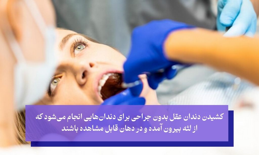چه تفاوتی بین کشیدن دندان عقل با جراحی و غیر جراحی وجود دارد