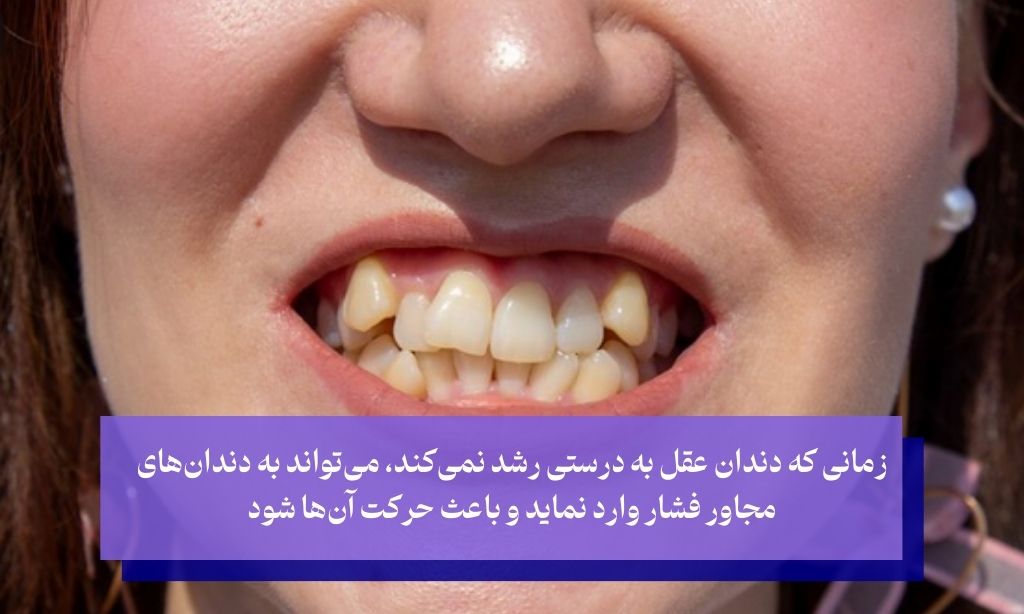 چه زمانی نیاز به کشیدن دندان عقل است