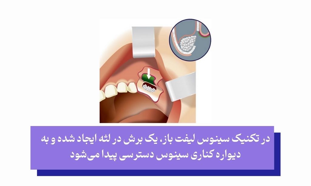 سینوس لیفت باز چیست