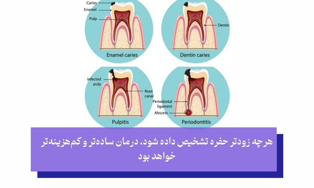 مراحل پیشرفت حفره دندان