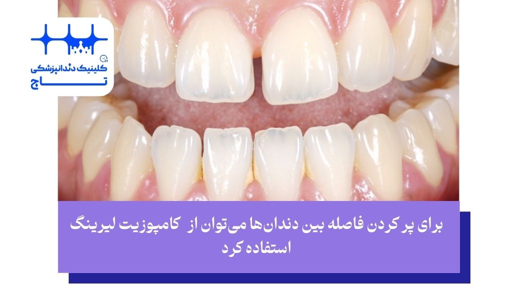 افراد مناسب برای کامپوزیت لیرینگ