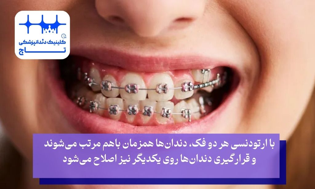 اهمیت ارتودنسی دو فک به صورت همزمان