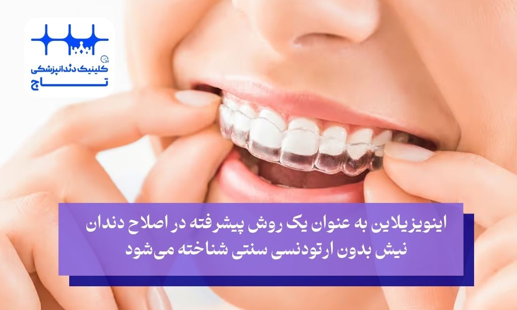 اینویزیلاین روش مدرن برای اصلاح دندان نیش بدون ارتودنسی