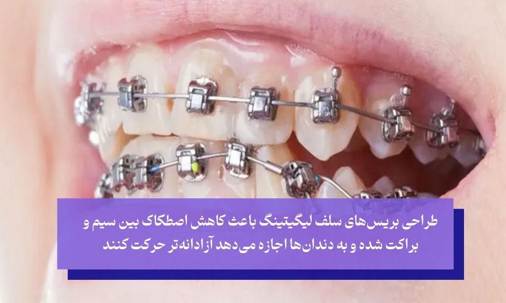 بریس‌های سلف لیگیتینگ (Self-Ligating Braces)؛ با هدف کاهش اصطکاک بین سیم و براکت