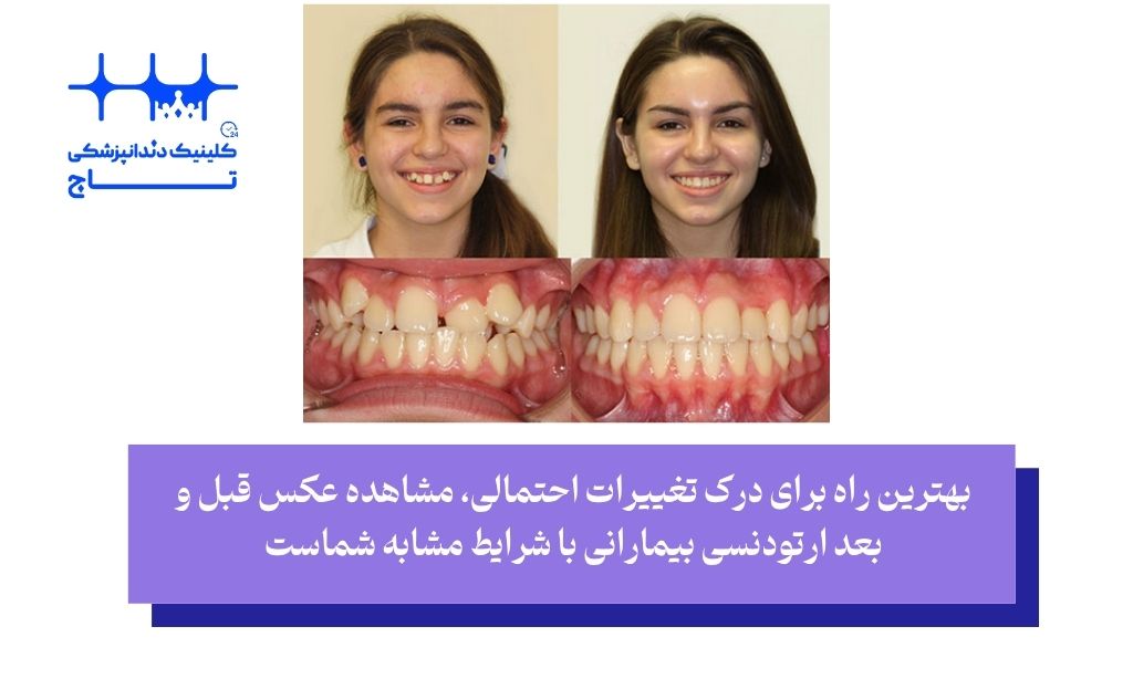 بهترین راه برای درک تغییرات احتمالی، مشاهده عکس قبل و بعد ارتودنسی بیمارانی با شرایط مشابه شماست
