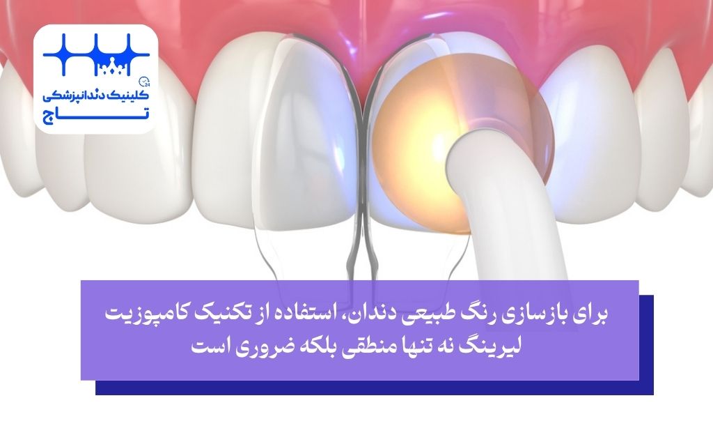 ضرورت استفاده از کامپوزیت لیرینگ