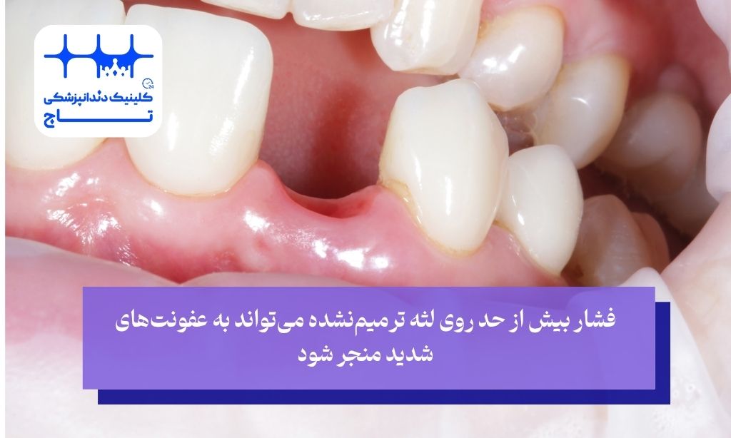 فشار بیش از حد روی لثه ترمیمنشده میتواند به عفونتهای شدید منجر شود