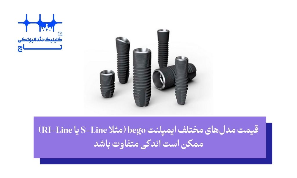 قیمت ایمپلنت bego