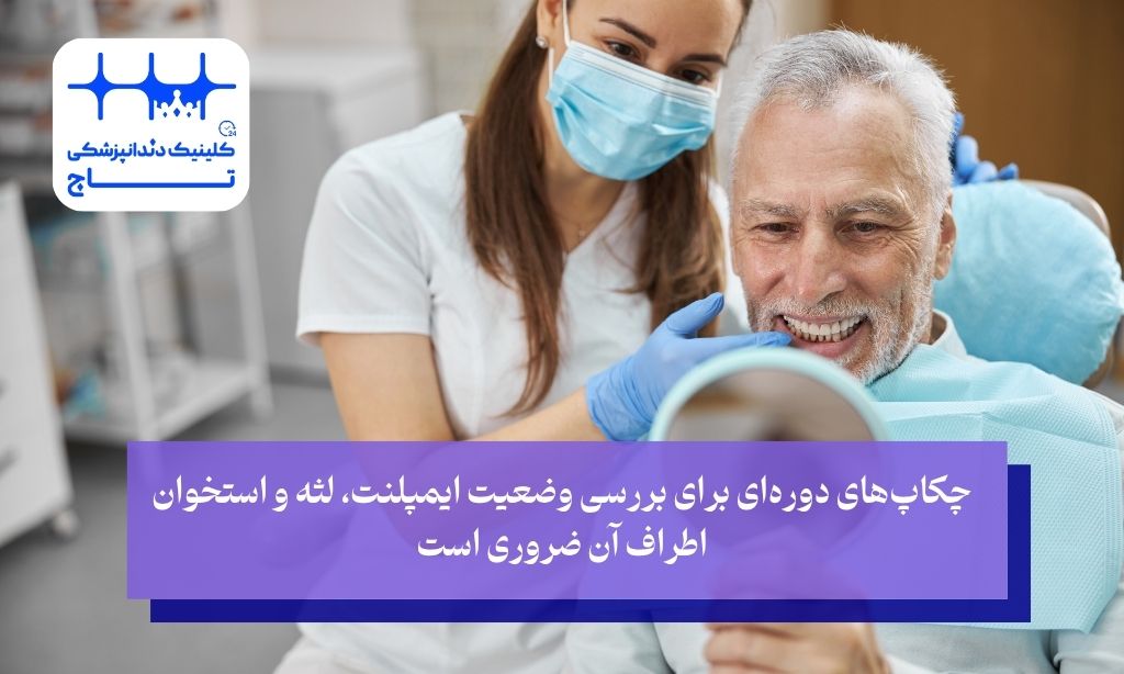 مراقبتهای پس از کاشت ایمپلنت bego؛ تضمین کننده موفقیت بلندمدت