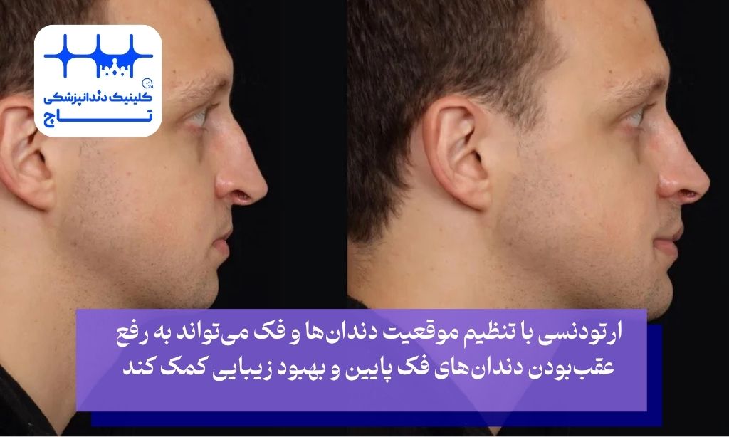 مزایای ارتودنسی دندان پایین