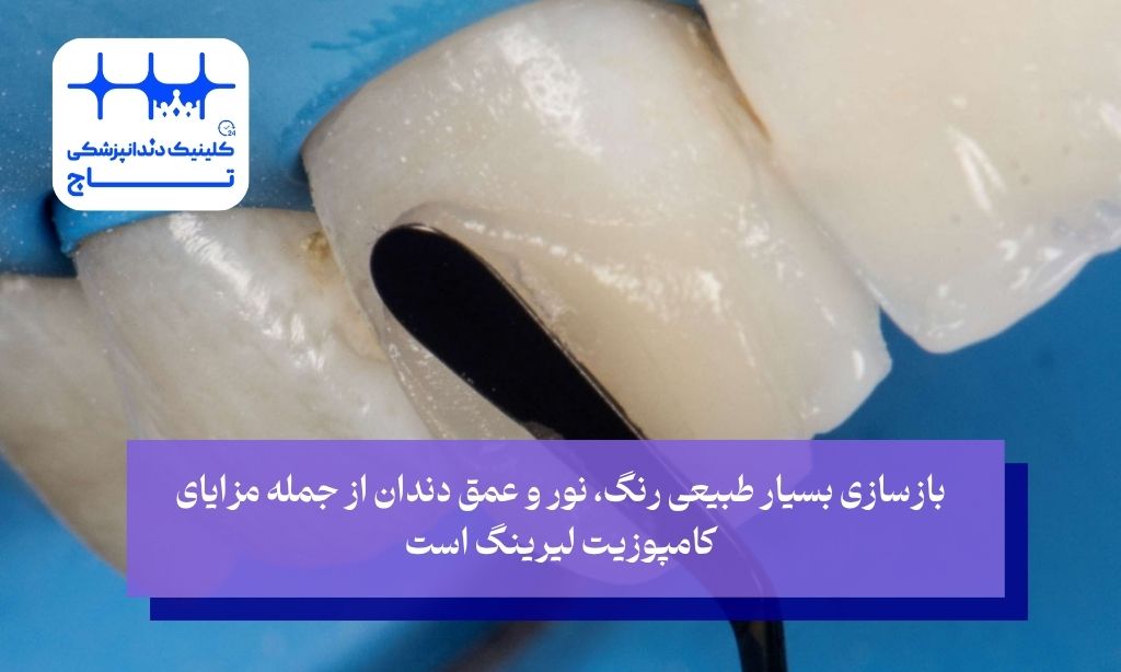 مزایا و معایب کامپوزیت لیرینگ