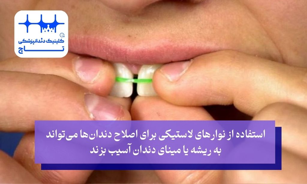 هشدار درباره روشهای خانگی برای اصلاح دندان نیش بدون ارتودنسی