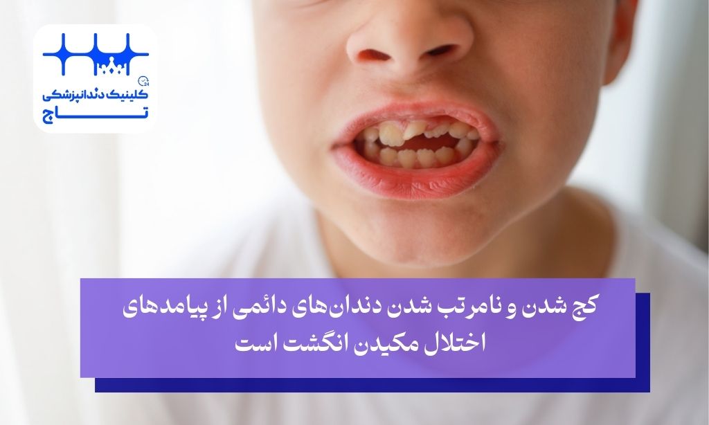 پیامدهای مکیدن انگشت روی ساختار دندان