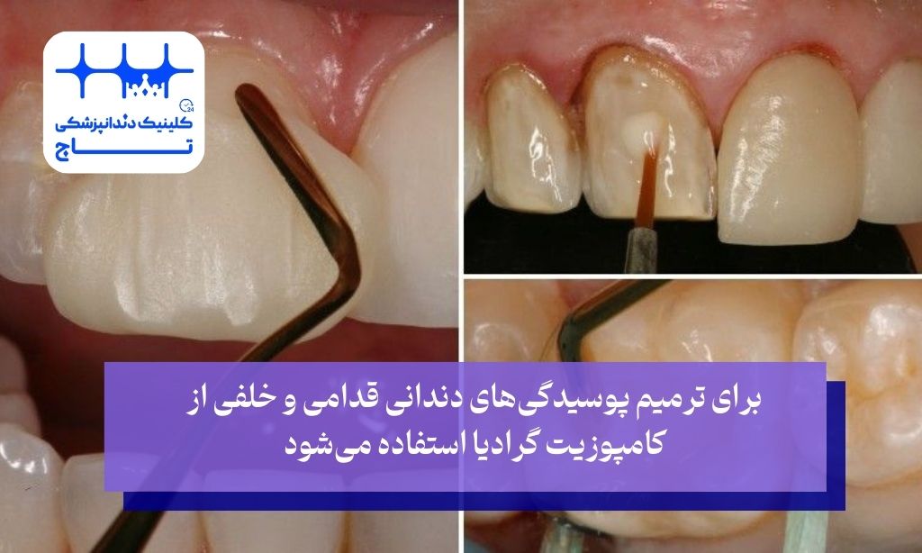 کاربردهای کامپوزیت گرادیا