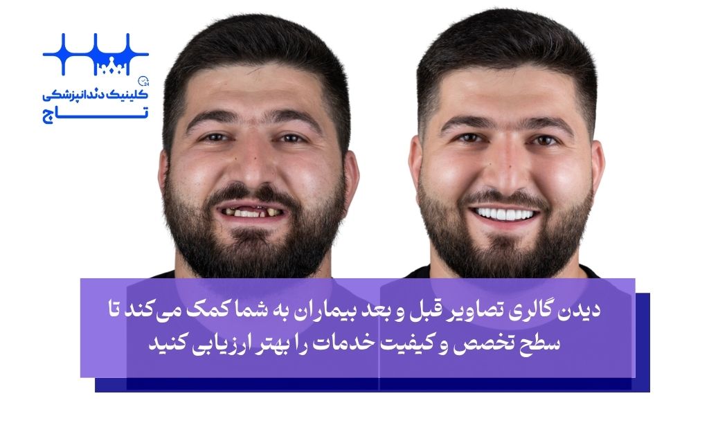 یافتن بهترین مرکز ایمپلنت دندان