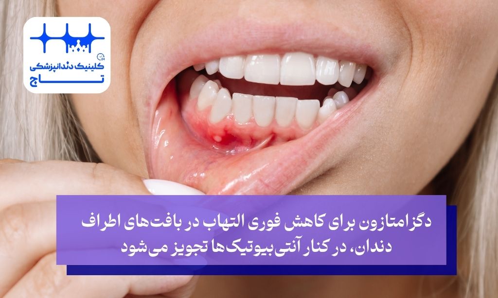 دگزامتازون و کاهش فوری التهاب