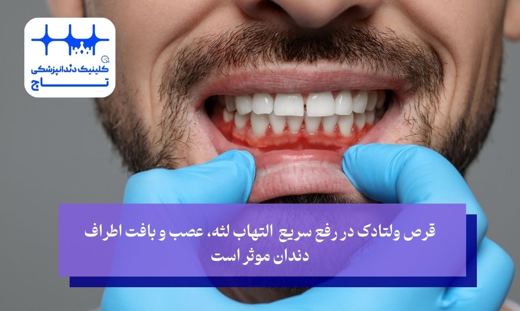 قرص ولتادک در رفع سریع التهاب لثه، عصب و بافت اطراف دندان موثر است