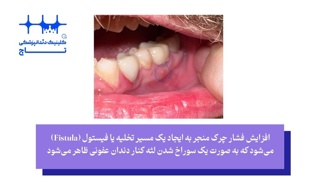 آبسه دندانی (Dental Abscess)؛ انفجار چرک و ایجاد مسیر تخلیه از طریق سوراخ شدن لثه