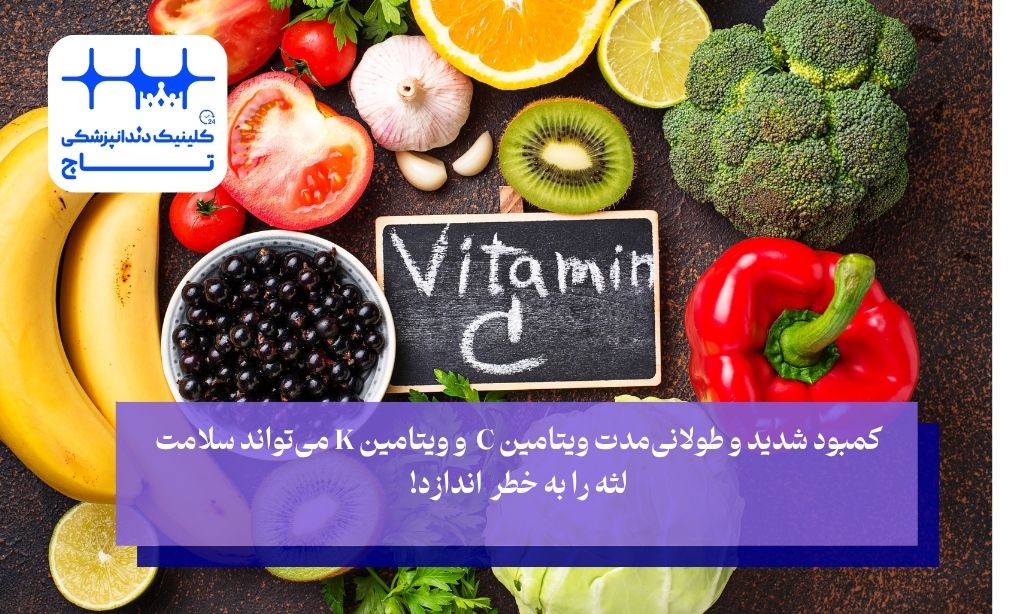 آیا کمبود ویتامینها میتواند مستقیماً باعث سوراخ شدن لثه شود