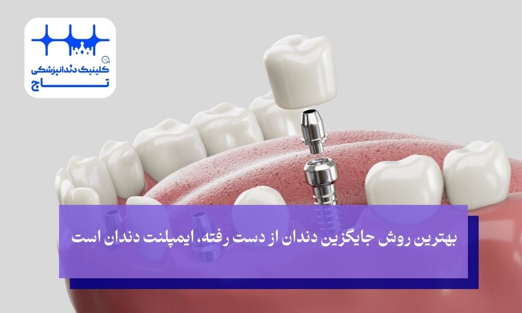 ایمپلنت دندان