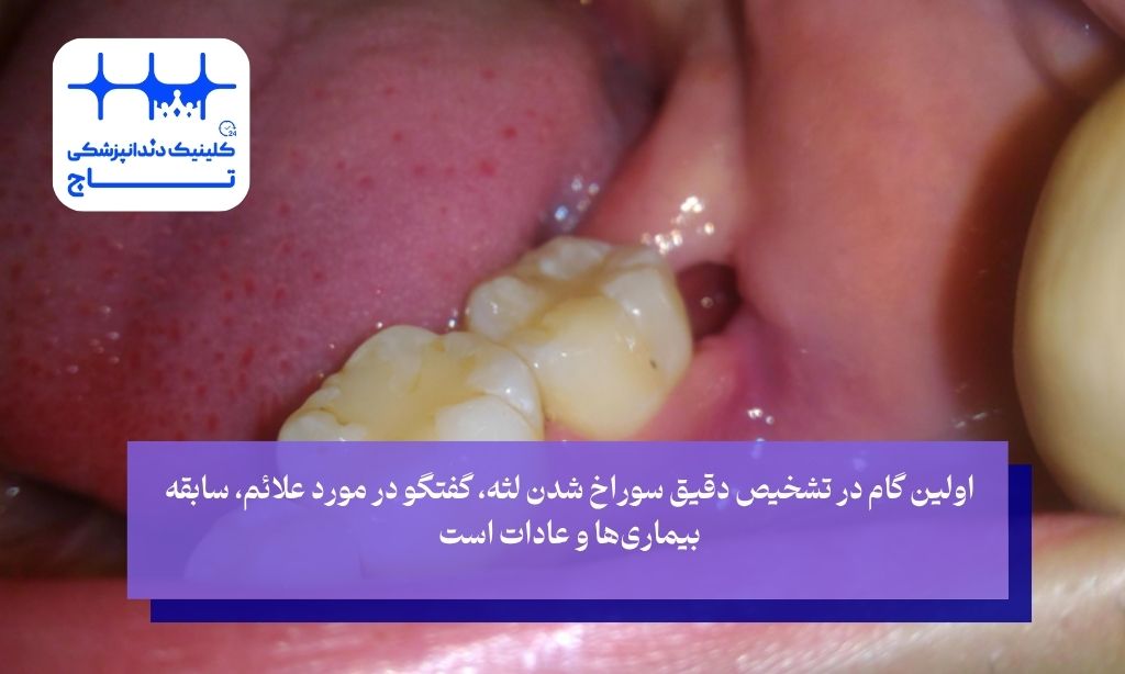 تشخیص دقیق سوراخ شدن لثه