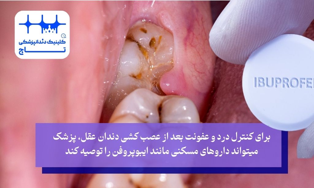 دارو برای دندان عقل عصب کشی شده