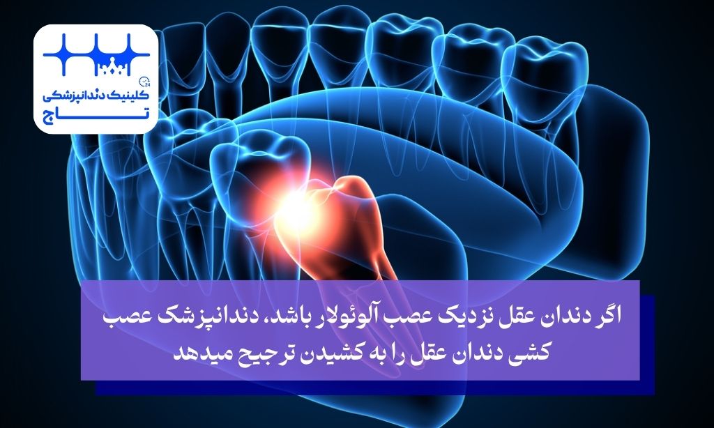 دلایل ترجیح عصب کشی دندان عقل به کشیدن